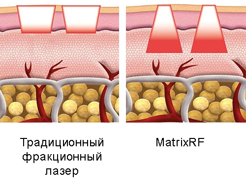Сублятивное фракционное RF-омоложение